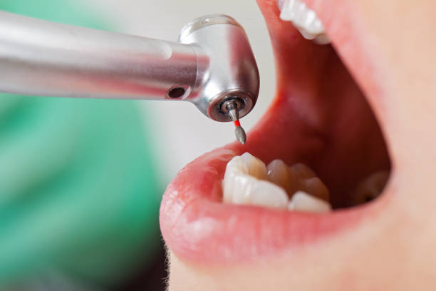Best Emergency Dentist for Lost Fillings or Crowns in Highland City, FL